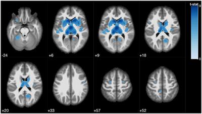 Identification of Cortical and Subcortical Correlates of Cognitive Performance in Multiple Sclerosis Using Voxel-Based Morphometry